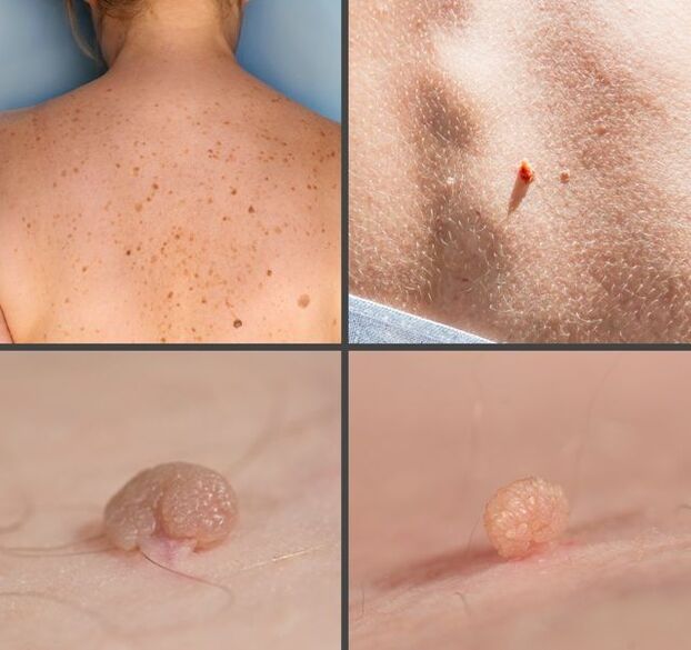 ¿Cómo se ven los papilomas en el cuerpo
