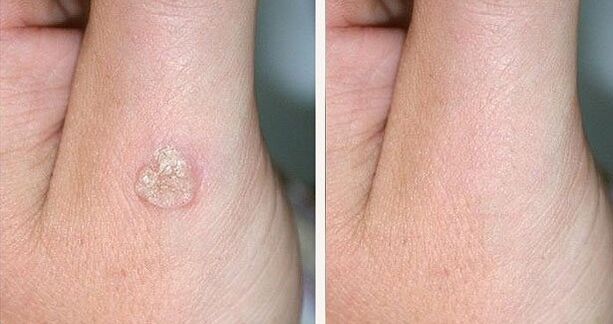 Fotos antes y después de eliminar las verrugas con remedios naturales.
