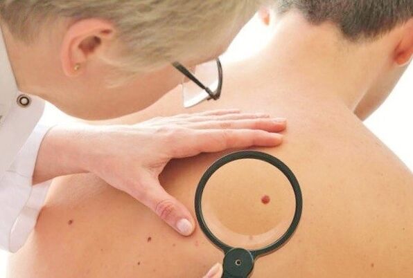 el médico determina el tipo de papiloma en la piel