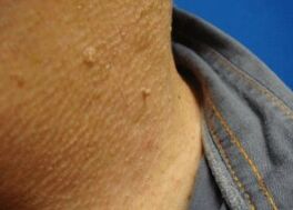 Papilomas filamentosos en el cuello.
